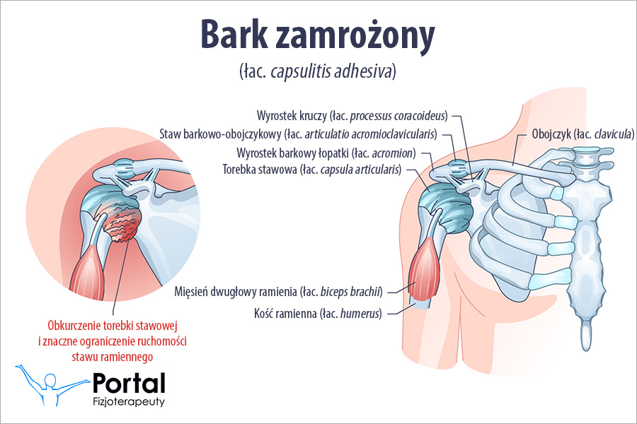 Bark zamrożony (łac. capsulitis adhesiva) Bark zamrożony (łac. capsulitis adhesiva)
