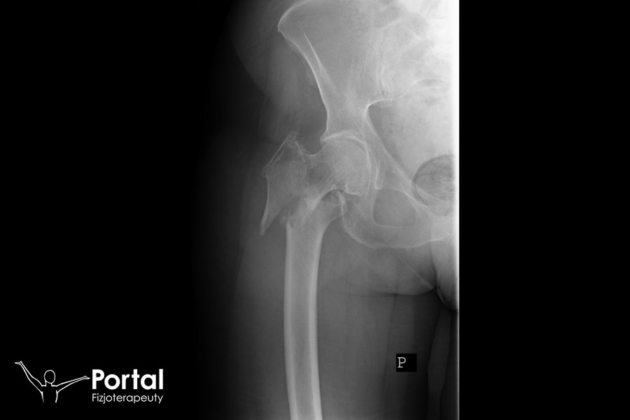 Złamanie kości Złamanie kości