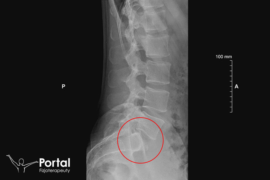 Kręgozmyk Kręgozmyk