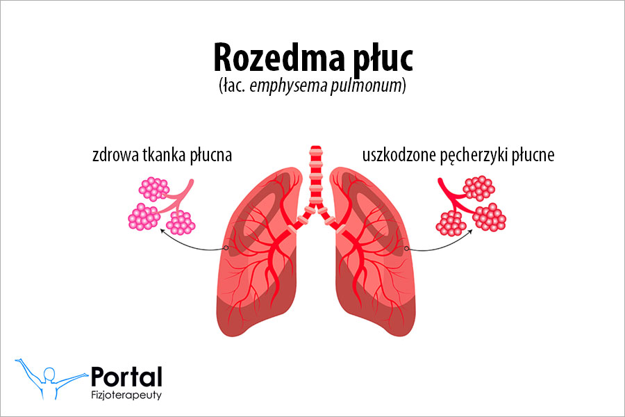 Rozedma płuc
