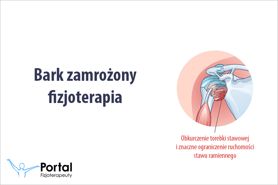 Bark zamrożony fizjoterapia