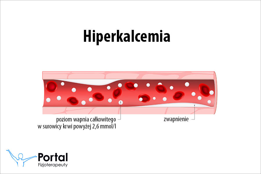 Hiperkalcemia Hiperkalcemia