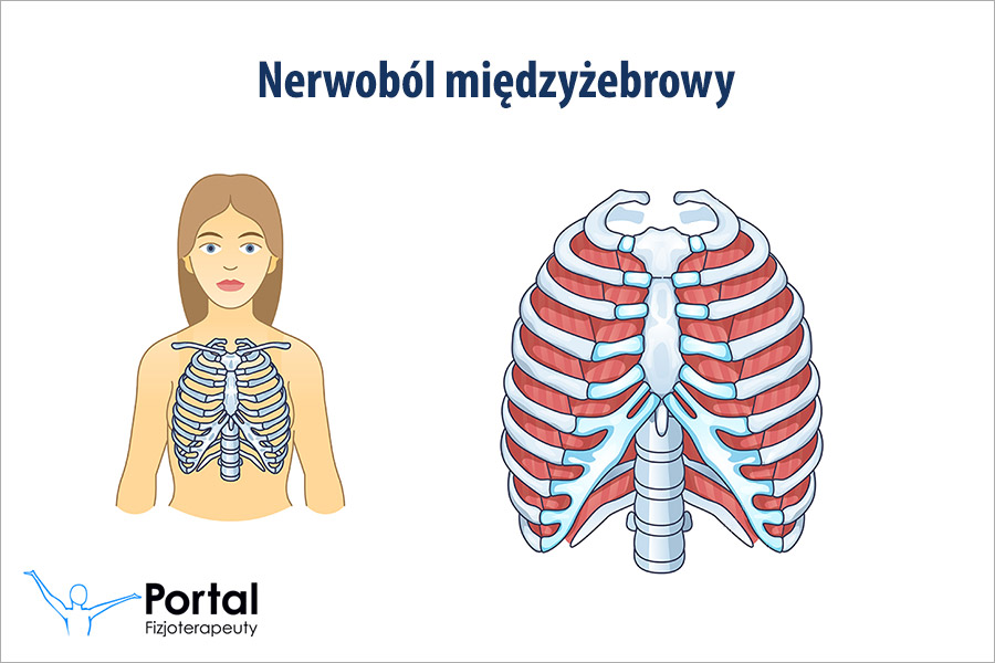 Nerwoból międzyżebrowy Nerwoból międzyżebrowy