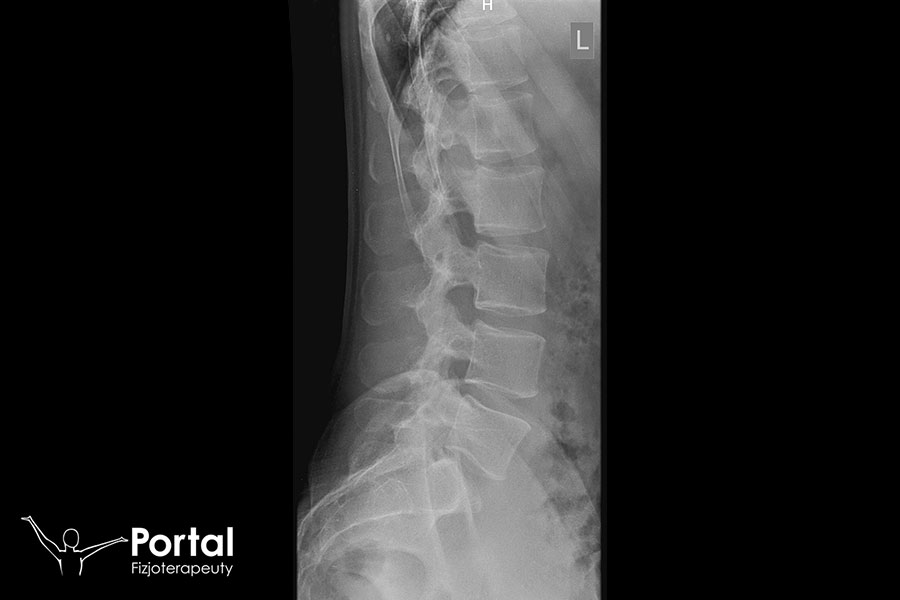 Ból w kręgosłupie lędźwiowo-krzyżowym