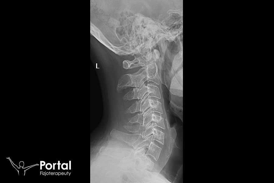 Ból w kręgosłupie szyjnym