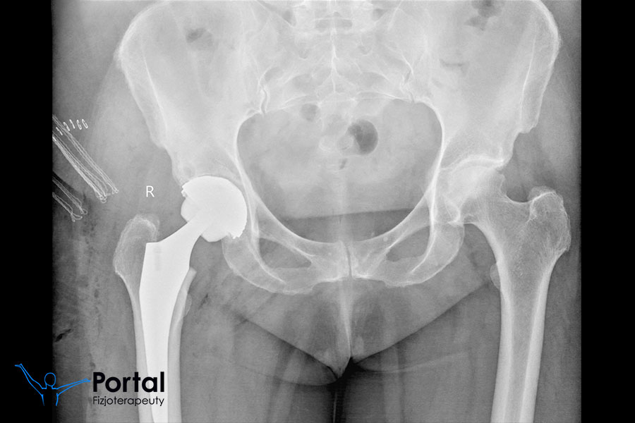 Endoprotezoplastyka staw biodrowy