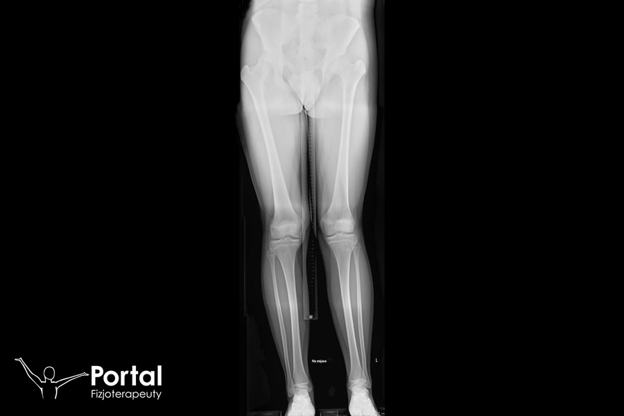 Koślawość kolana Koślawość kolana