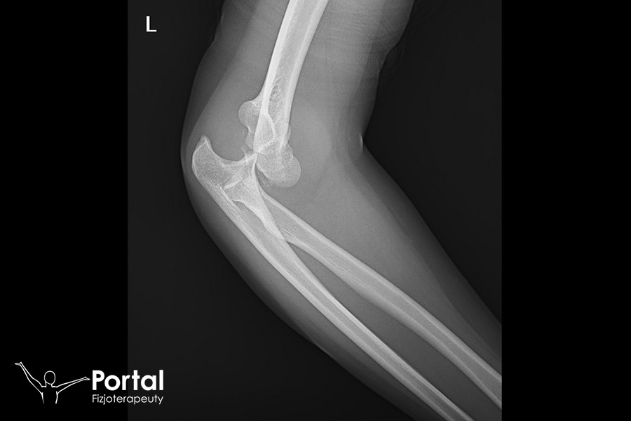 Brak kongruencji stawu łokciowego Brak kongruencji stawu łokciowego