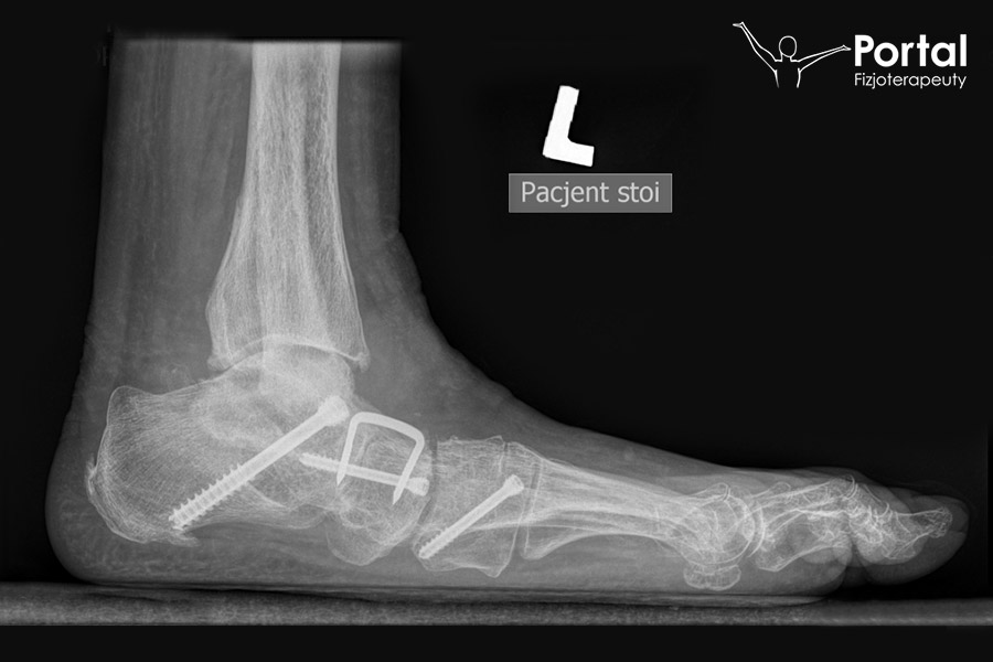 Operacja płaskostopia Operacja płaskostopia