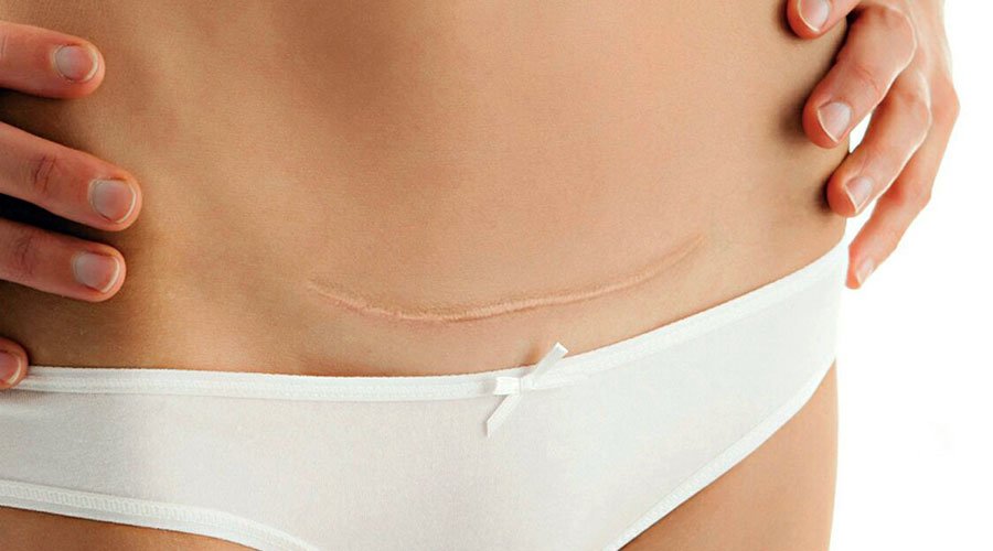 Usprawnienie po cięciu cesarskim