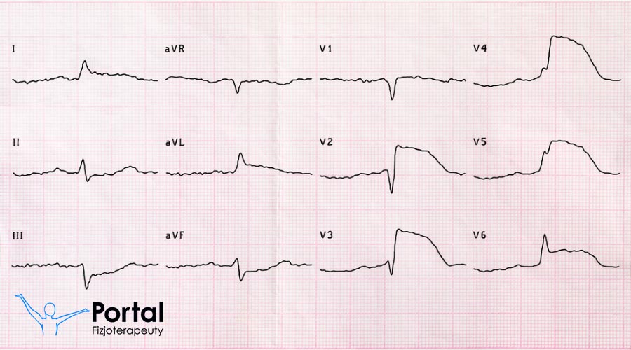 Ostre zespoły wieńcowe
