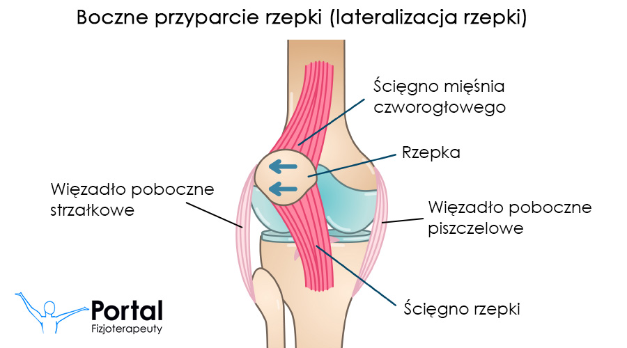 Boczne przyparcie rzepki (lateralizacja rzepki)