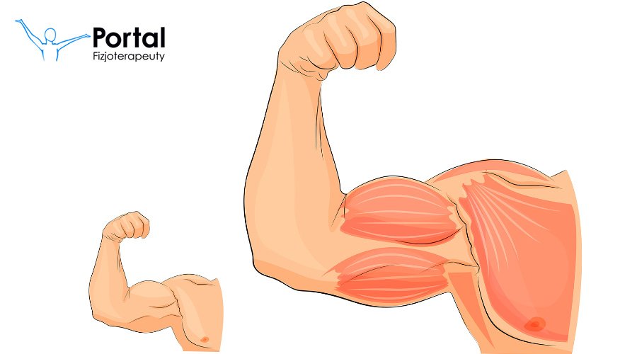 Hiperplazja mięśni