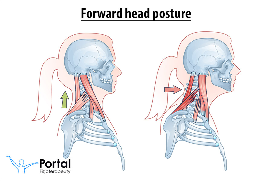 Forward head posture