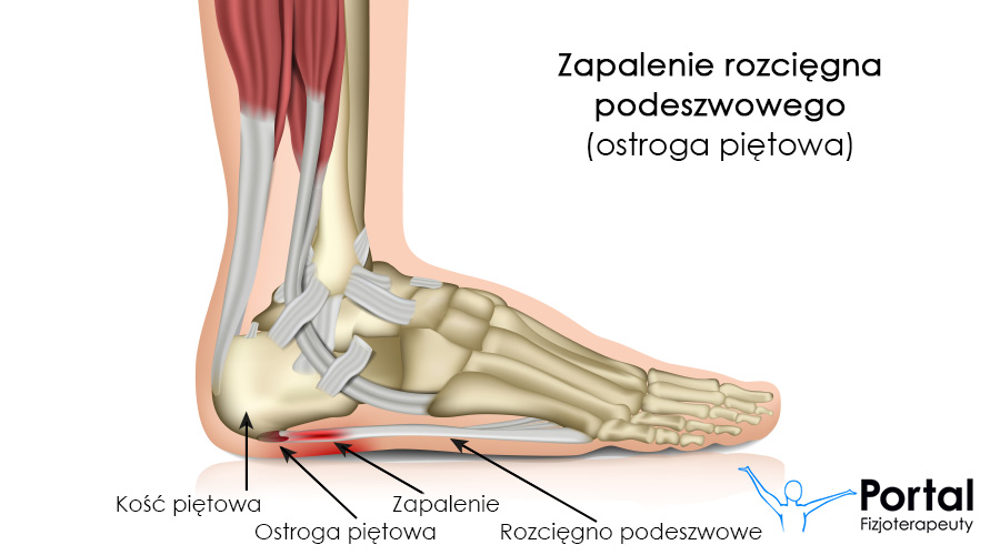 Zapalenie rozcięgna podeszwowego (ostroga piętowa)