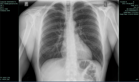 RTG klatki piersiowej PA