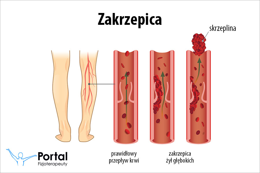 Zakrzepica