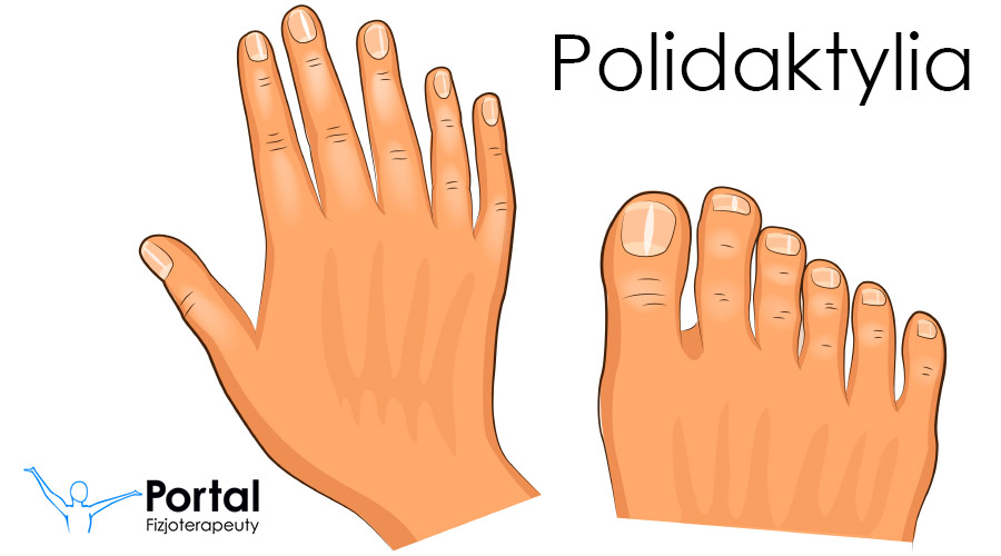 Polidaktylia