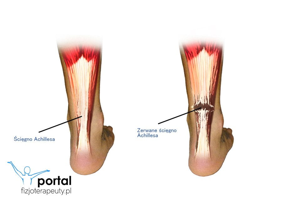 Ścięgno Achillesa - uszkodzenie