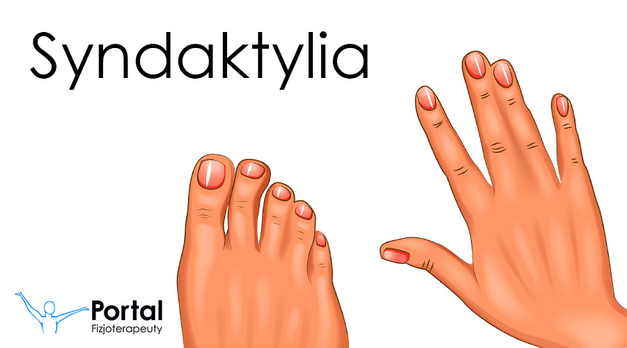 Syndaktylia