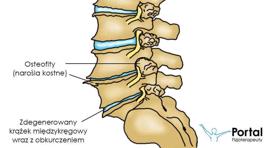 Zwyrodnienie kręgosłupa