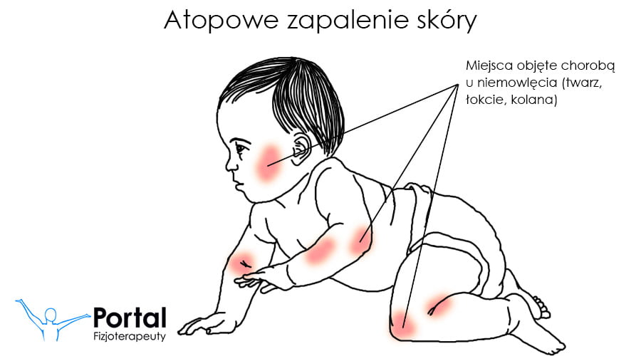 Atopowe zapalenie skóry
