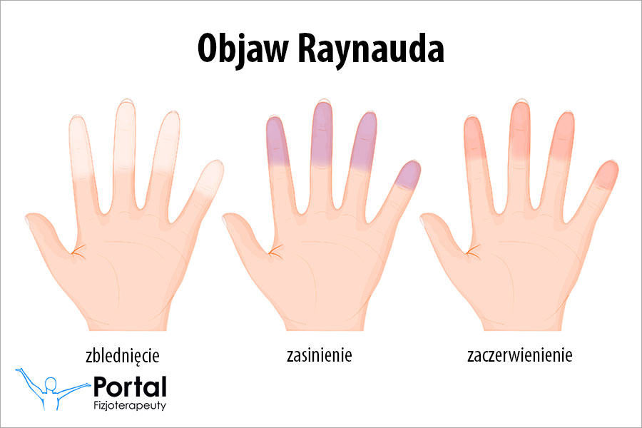 Objaw Raynauda