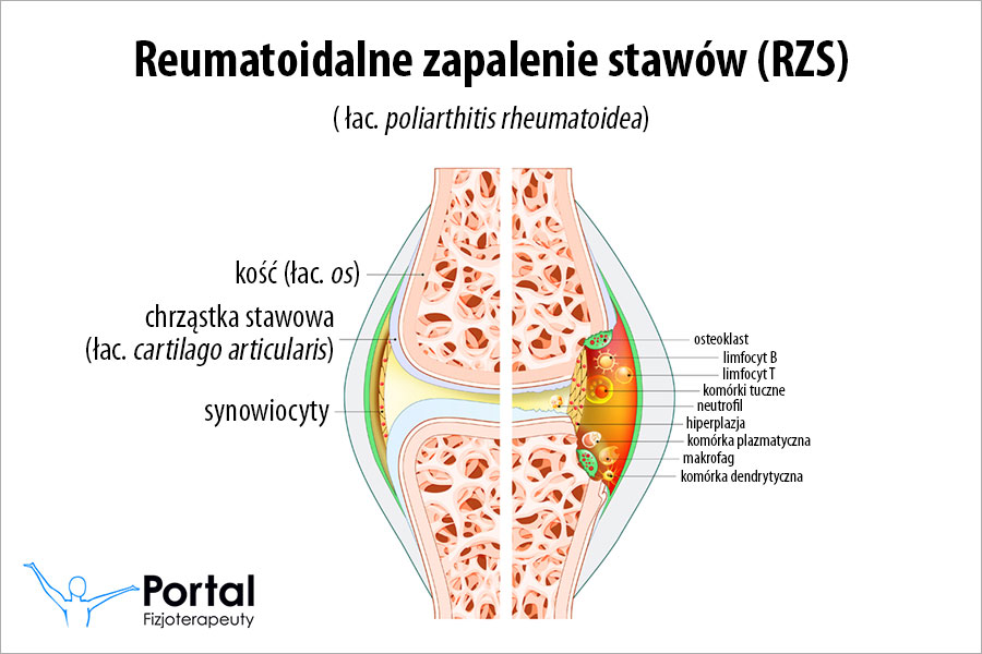 Reumatoidalne zapalenie stawów