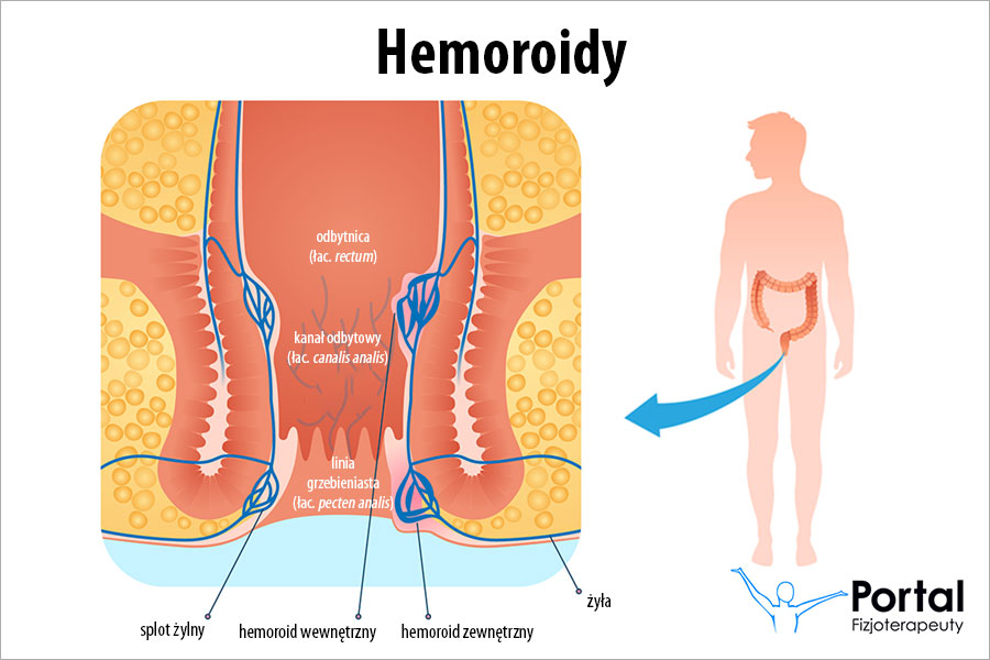 hemoroidy