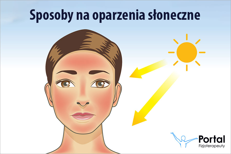 Sposoby na oparzenia słoneczne