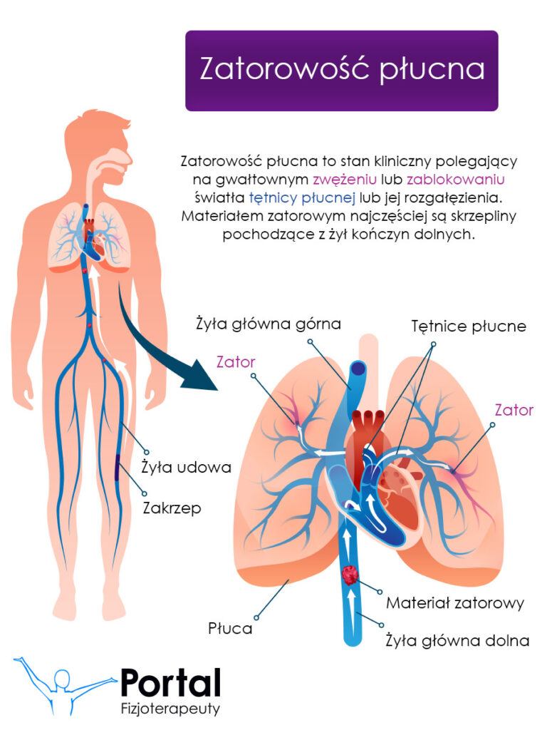 Zatorowość płucna