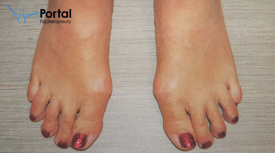 Paluch koślawy - haluks