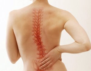 Skolioza fizjoterapia