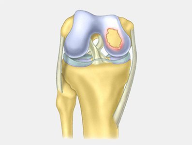 Usprawnianie po operacjach chrząstki stawu kolanowego ikona