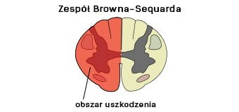 Zespół Browna-Sequarda