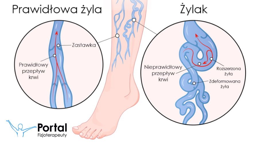Żylaki podudzi - fizjoterapia