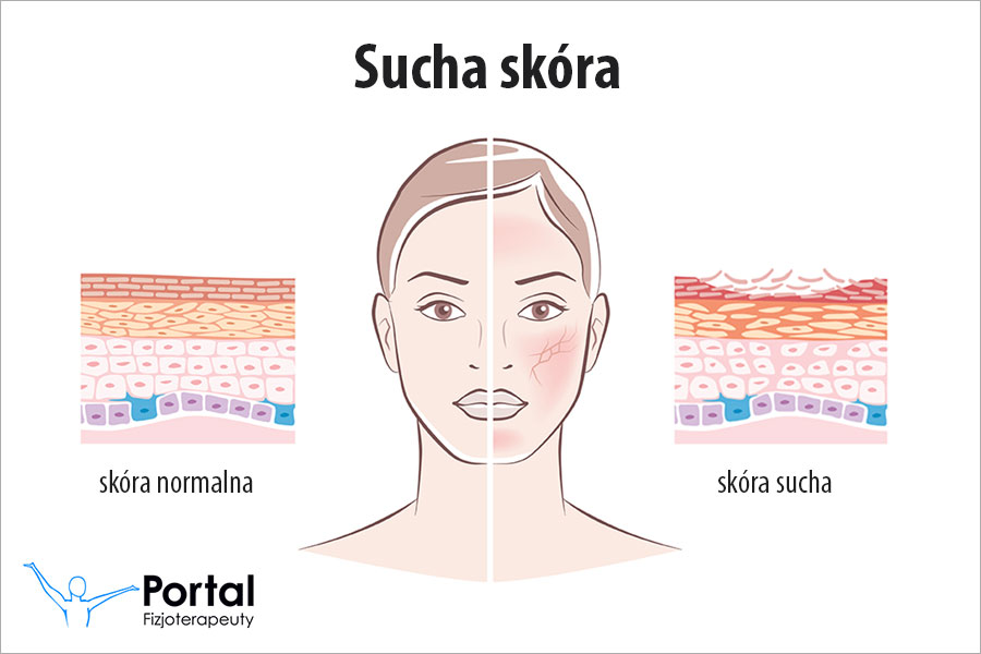 sucha skóra