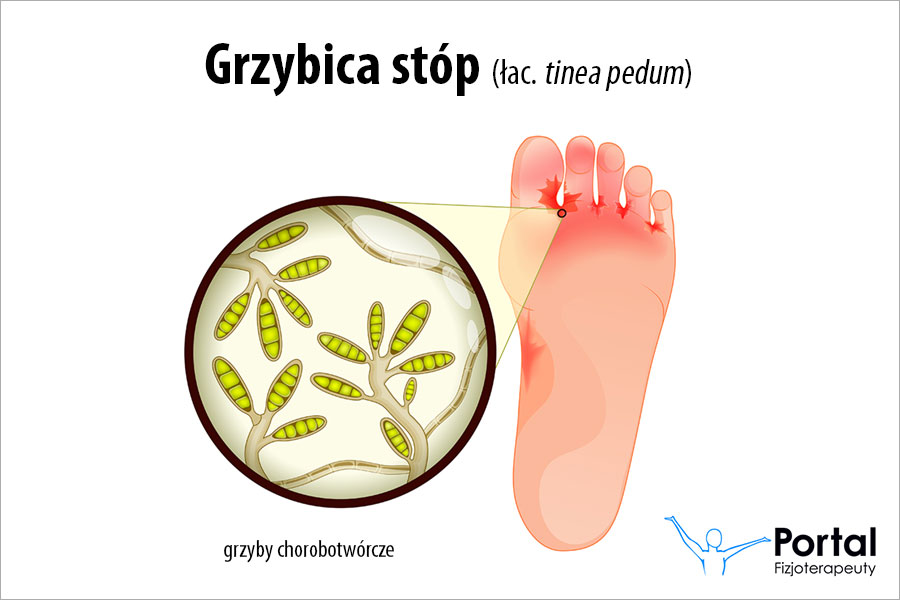 Grzybica stóp