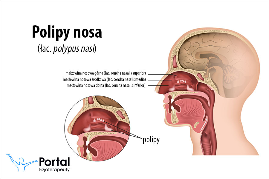 Polipy nosa
