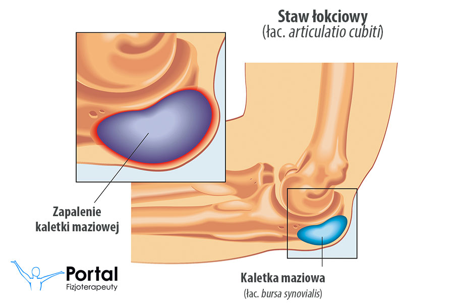 Zapalenie kaletki maziowej