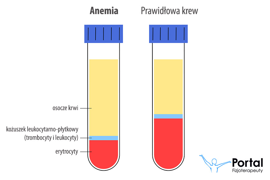 Anemia