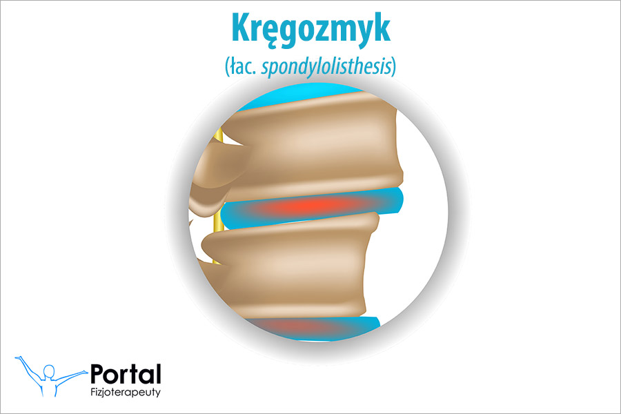 Kręgozmyk (łac. spondylolisthesis)