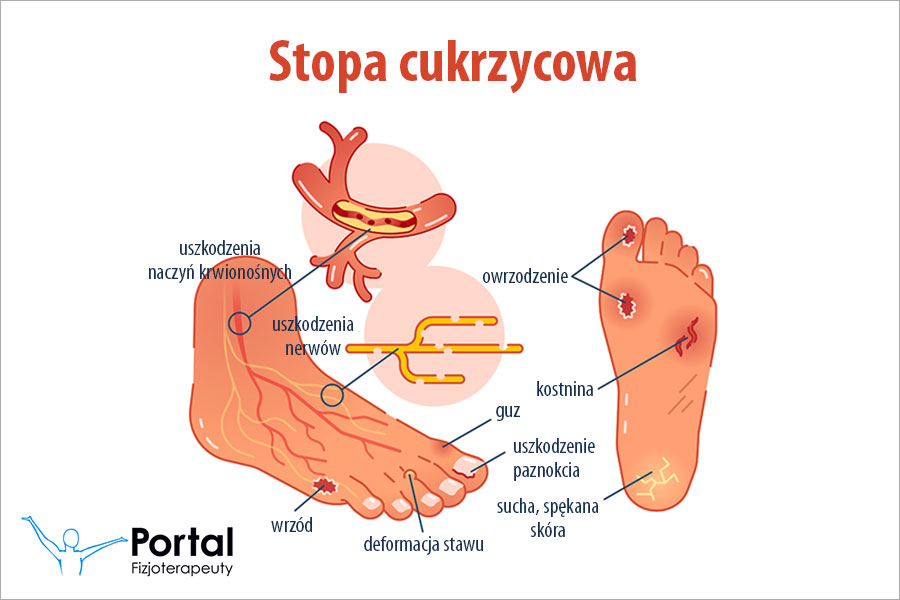 Stopa cukrzycowa