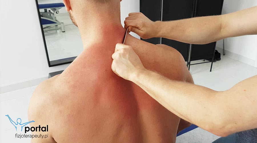 Uszkodzenie mięśni pleców jest stanem charakteryzującym się naciągnięciem, bądź zerwaniem mięśnia lub jego ścięgna. Oceniane jest w skali od I