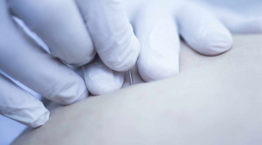 Igłoterapia - suche igłowanie (dry needling)