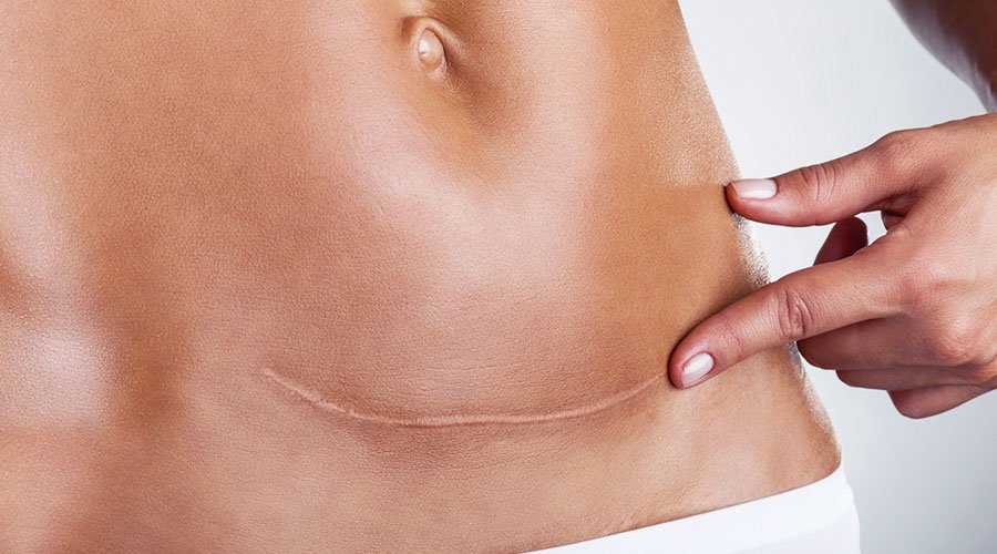 Mobilizacja blizny po cesarskim cięciu