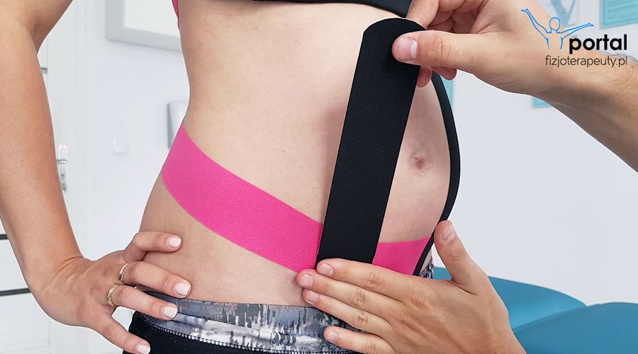 Kinesiotaping w ciąży