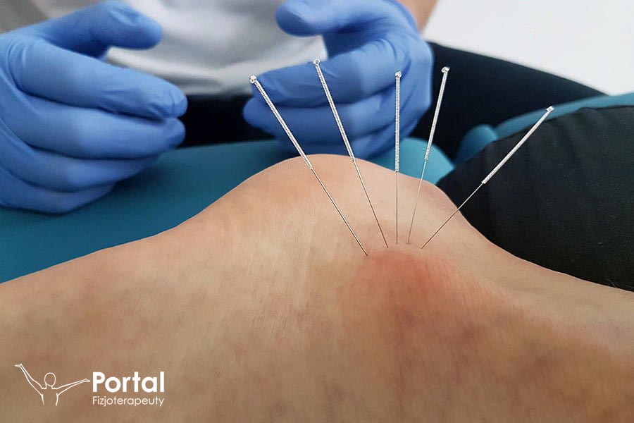 Suche igłowanie (igłoterapia)