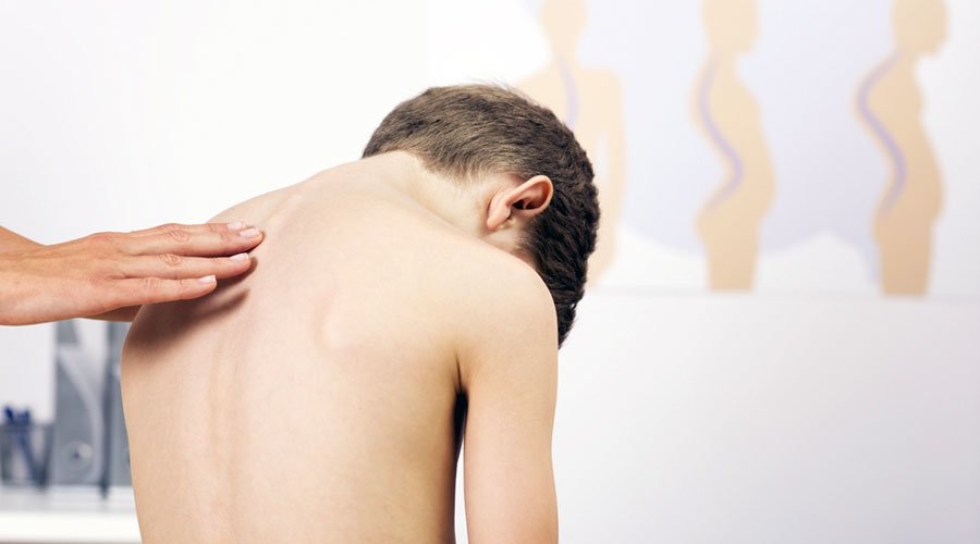 Skolioza - przyczyny, objawy, leczenie