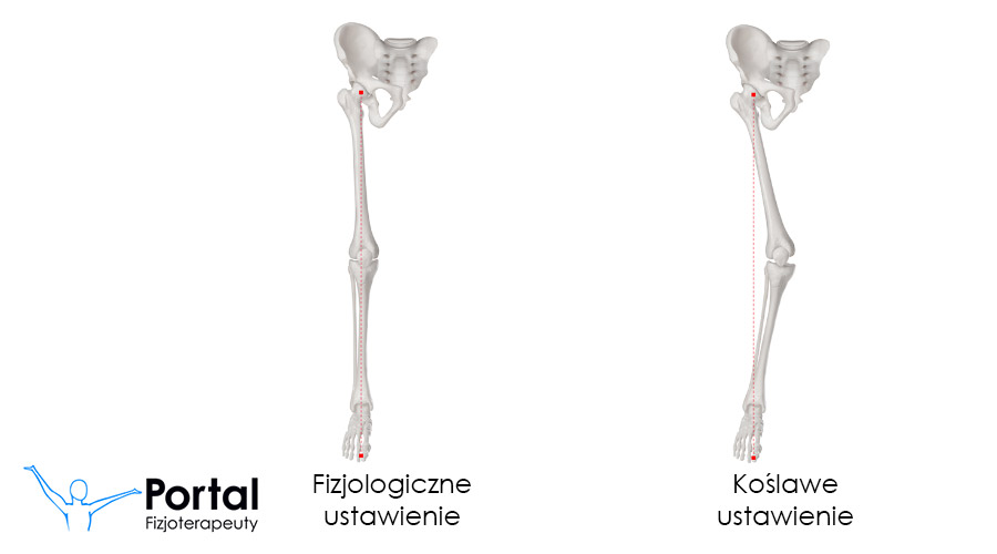 Kolana koślawe - przyczyny, objawy, leczenie